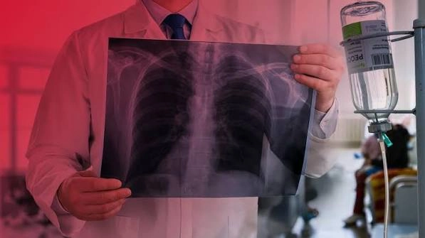 В Україні за місяць виявили понад 1,5 тисячі хворих на туберкульоз
